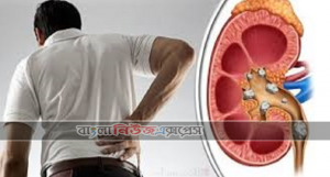 কিডনিতে পাথর হওয়ার কারণ
