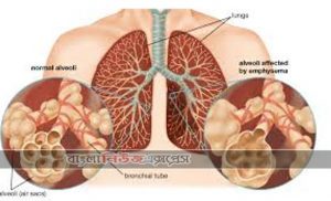 স্ট্রোকে আক্রান্ত হলে তাৎক্ষণিক করণীয়