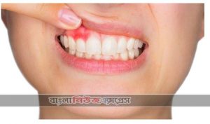 দাঁতের ক্ষয় প্রতিরোধ করুন
