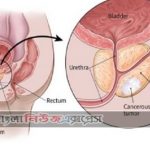 মূত্রথলির ক্যানসার এবং করণীয়
