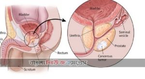 মূত্রথলির ক্যানসার এবং করণীয়