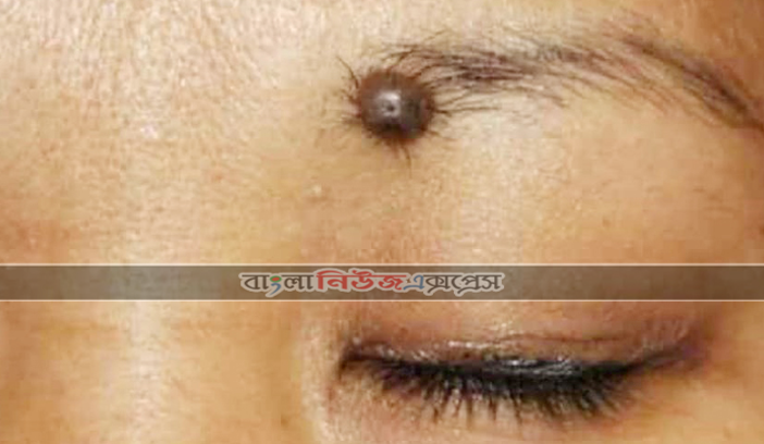 ত্বকে আঁচিল ও কালো দাগ সমস্যায় কী করবেন