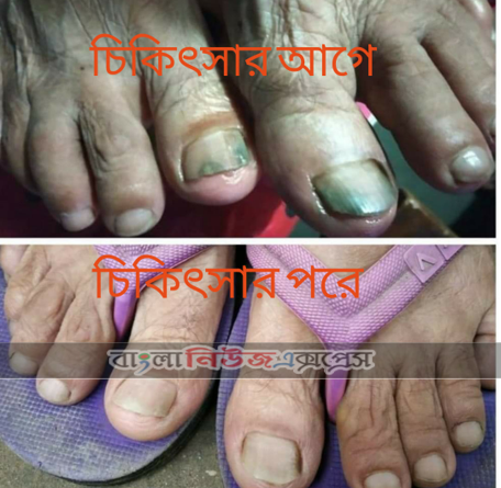 নখের ইনফেকশন ও প্রতিরোধ এর উপায়