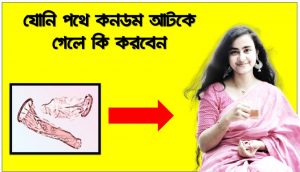 শরীরের ভেতর কনডম আটকে গেলে কী করবেন?,যোনি পথে কনডম আটকে গেলে কি করবেন, যৌনাঙ্গ বা গুহ্যদ্বারে কন্ডোম আটকে গেলে কী করবেন?, বীর্য আটকে রাখার কোনো উপায় আছে কি