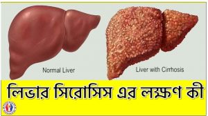 লিভার সিরোসিস এর লক্ষণ কী, যেসব লক্ষণে বুঝবেন লিভার সিরোসিস, লিভার সিরোসিস: এই লক্ষণগুলো কি আপনার আছে?