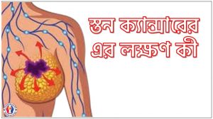 স্তন ক্যান্সারের এর লক্ষণ কী, যেসব লক্ষণে বুঝবেন স্তন ক্যান্সারের, স্তন ক্যান্সারের: এই লক্ষণগুলো কি আপনার আছে?