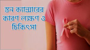স্তন ক্যান্সারের কারণ লক্ষণ ও চিকিৎসা, পাকস্থলীর ক্যান্সারের লক্ষণ ও প্রতিকার,স্তন ক্যান্সারের লক্ষণ ও প্রতিকার