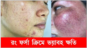 রং ফর্সা ক্রিমে ভয়াবহ ক্ষতি, ত্বক ফর্সায় ক্রিমের পার্শ্ব প্রতিক্রিয়া, চামড়া পুড়িয়ে ফর্সা করে যে সকল ক্রিম,স্কিন সাইন ক্রিম এর পার্শ্ব প্রতিক্রিয়া, ফর্সা হওয়ার মাসুল গুনে চামড়ায় ক্ষত