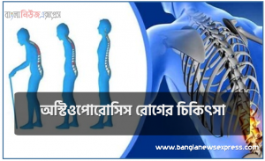 অস্টিওপোরোসিস রোগের চিকিৎসা,অস্টিওপোরোসিস রোগের লক্ষণ