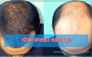 মাথা চুল গজায়,টাক মাথায় চুল গজাবে,চুল পড়া