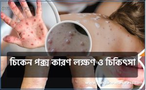 চিকেন পক্স কারণ লক্ষণ ও চিকিৎসা, চিকেন পক্স লক্ষণ ও প্রতিকার