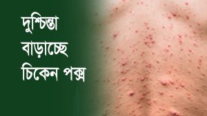চিকেন পক্স হলে কি করবেন,চিকেন পক্স এর চিকিৎসা