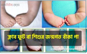 ক্লাব ফুট বা শিশুর জন্মগত বাঁকা পা, শিশুর জন্মগত বাঁকা পা ঠিক করা সম্ভব