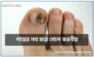 পায়ের নখ মরে গেলে করনীয়,পায়ের আঙ্গুলের নখের সমস্যা