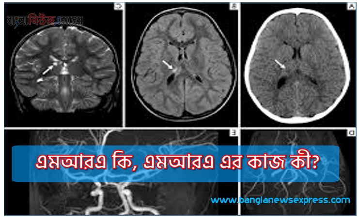 এমআরএ কেন করা হয়,এমআরএ কি, এমআরএ এর কাজ কী?,এমআরএ কি ধরনের প্রযুক্তি?, এমআরএ ব্যবহার,এমআরএ ভালো খারাপ দিক,এমআরএ কেন গুরুত্বপূর্ণ?,এমআরএ ব্যবহার সতর্কতা,এক্স-রে থেরাপি এবং এর প্রভাব সম্পর্কে জানতে চাই,এমআরএ করার সময় কোন কোন বিষয়গুলির প্রতি সতর্ক থাকতে হবে?,