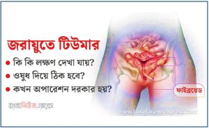 জরায়ু টিউমারের এর কারণ লক্ষণ প্রতিরোধ ও চিকিৎসা 2 জরায়ু টিউমারের এর কারণ লক্ষণ প্রতিরোধ ও চিকিৎসা, জরায়ু টিউমারের রোগের প্রধান চিকিৎসা কি?,জরায়ু টিউমারের প্রতিকারের উপায় কী?,মানুষের জরায়ু টিউমারের রোগের চিকিৎসা কী?,জরায়ু টিউমারের প্রতিরোধের উপায়?