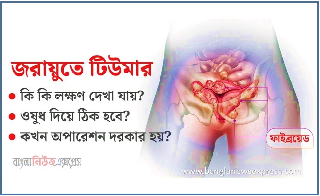 জরায়ু টিউমারের এর কারণ লক্ষণ প্রতিরোধ ও চিকিৎসা
