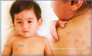 হাম এর লক্ষণ চিকিৎসা এবং প্রতিরোধ, হাম লক্ষণ, হাম কারণ, হাম রোগ নির্ণয় , হাম চিকিৎসা, হাম রোগের প্রতিকার ও প্রতিরোধ কী?,হামের ৫ টি লক্ষণ কি কি?,হাম সারতে কতদিন লাগে?,হাম ভাইরাসের লক্ষণ কি কি?,