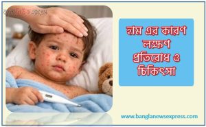 হাম এর কারণ লক্ষণ প্রতিরোধ ও চিকিৎসা, হাম রোগের প্রধান চিকিৎসা কি?, হাম প্রতিকারের উপায় কী?,মানুষের হাম রোগের চিকিৎসা কী?,হাম প্রতিরোধের উপায়?