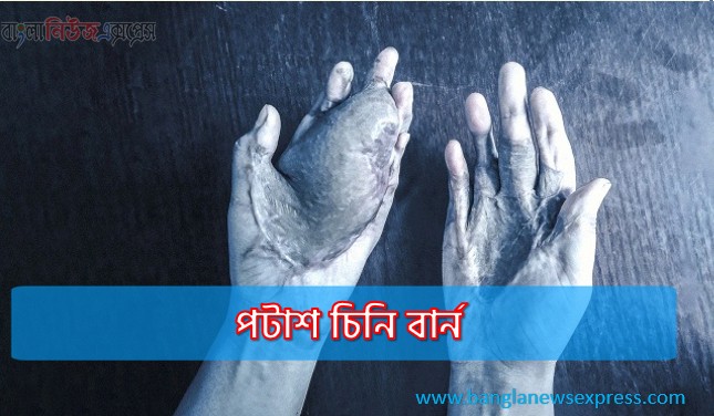 পটাশ চিনি বার্ন, অনলাইনে প্রতারণার ফাঁদে পটাশ চিনি বার্ন,যেভাবে হাত হারাচ্ছে কিশোরী-যুবতীরা পটাশ চিনি বার্ন,প্রতারণার ফাঁদে পটাশ চিনি বার্ন,পটাশ চিনি বার্ন ফাঁদ,